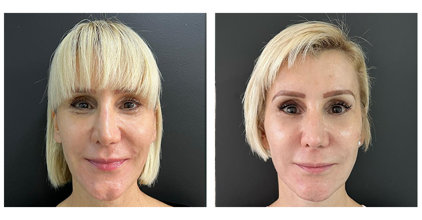 cirugia antes y despues