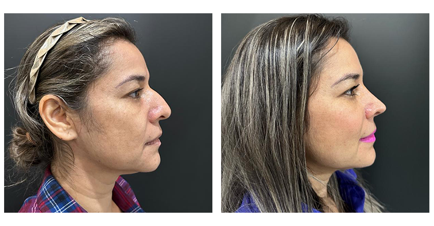 rinoplastia antes y despues