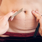 que-es-la-abdominoplastia.webp