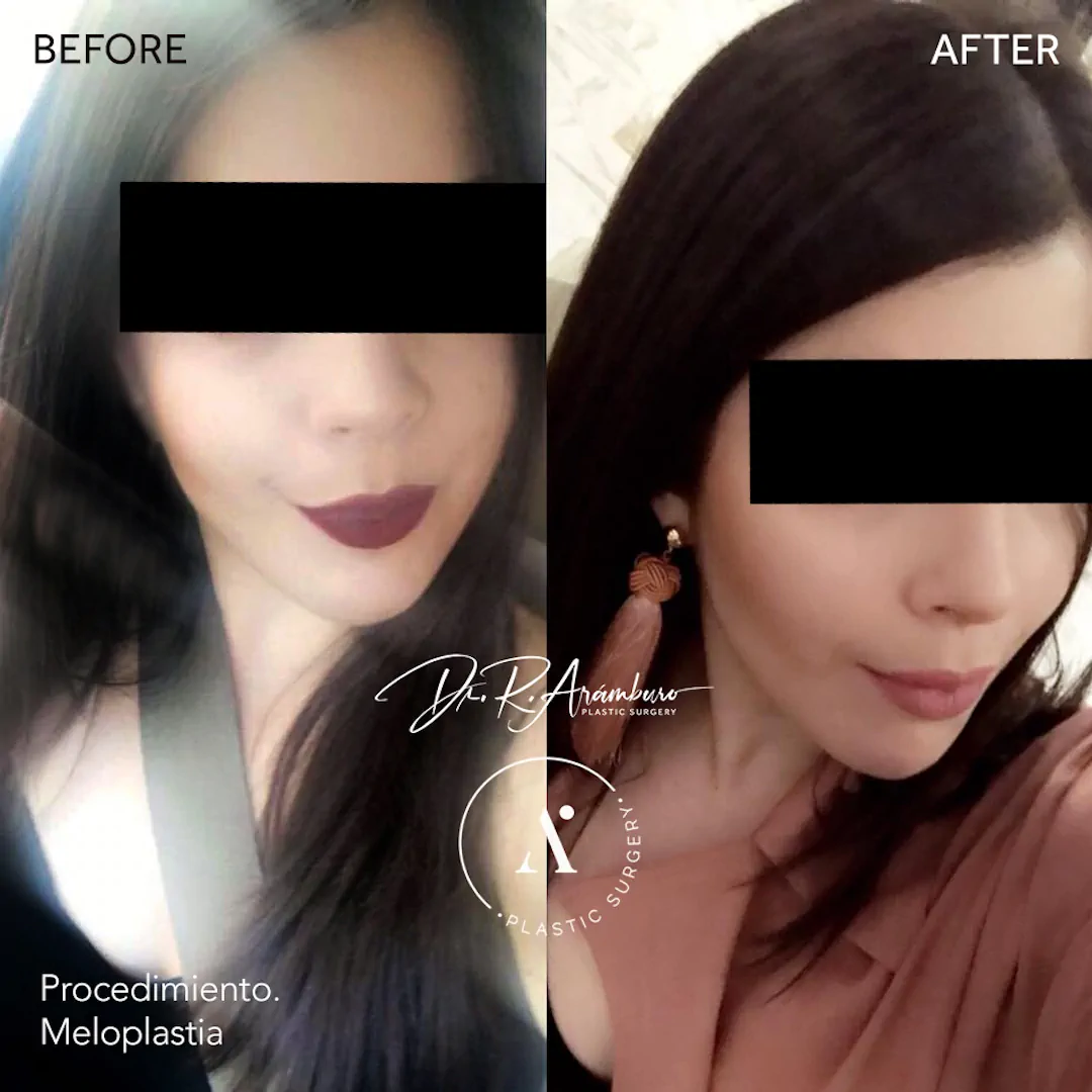 MELOPLASTIA
