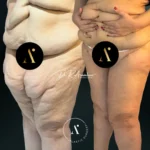 MUSLOPLASTIA