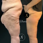 MUSLOPLASTIA(1)