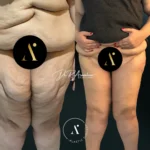 MUSLOPLASTIA(2)