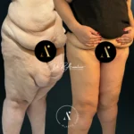 MUSLOPLASTIA(3)