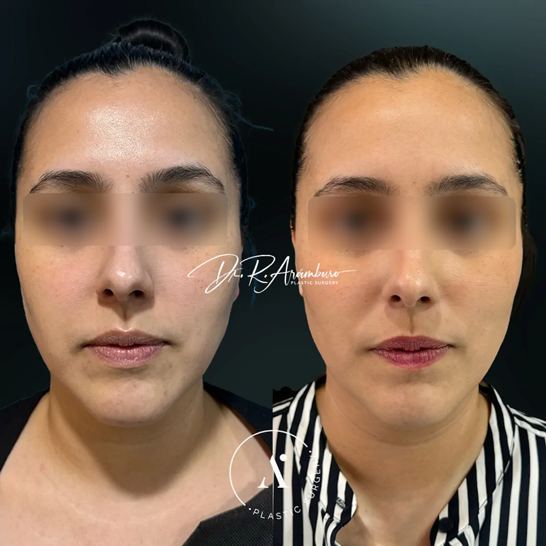 lipopapada(1)
