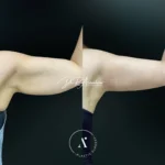 BLAQUIPLASTIA(2)