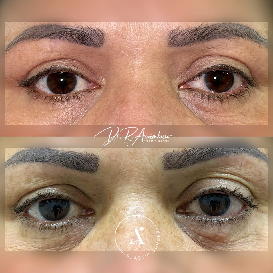8.- Blefaroplastia consultorio