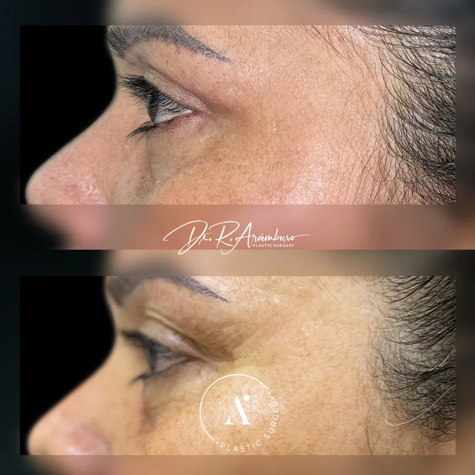 8.2-Blefaroplastia consultorio
