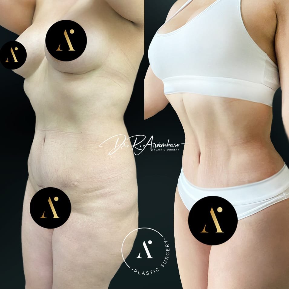 ABDOMINOPLASTIA
