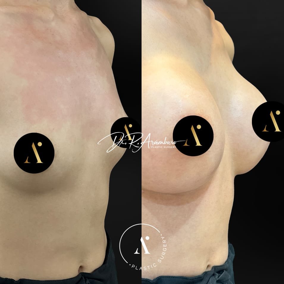 internalbra(1)