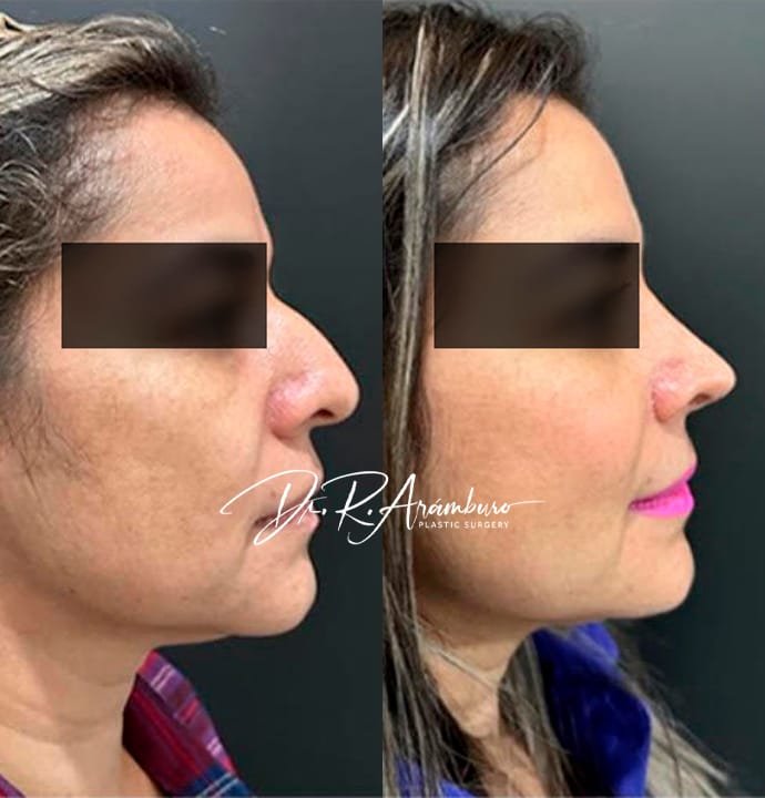 rinoplastia