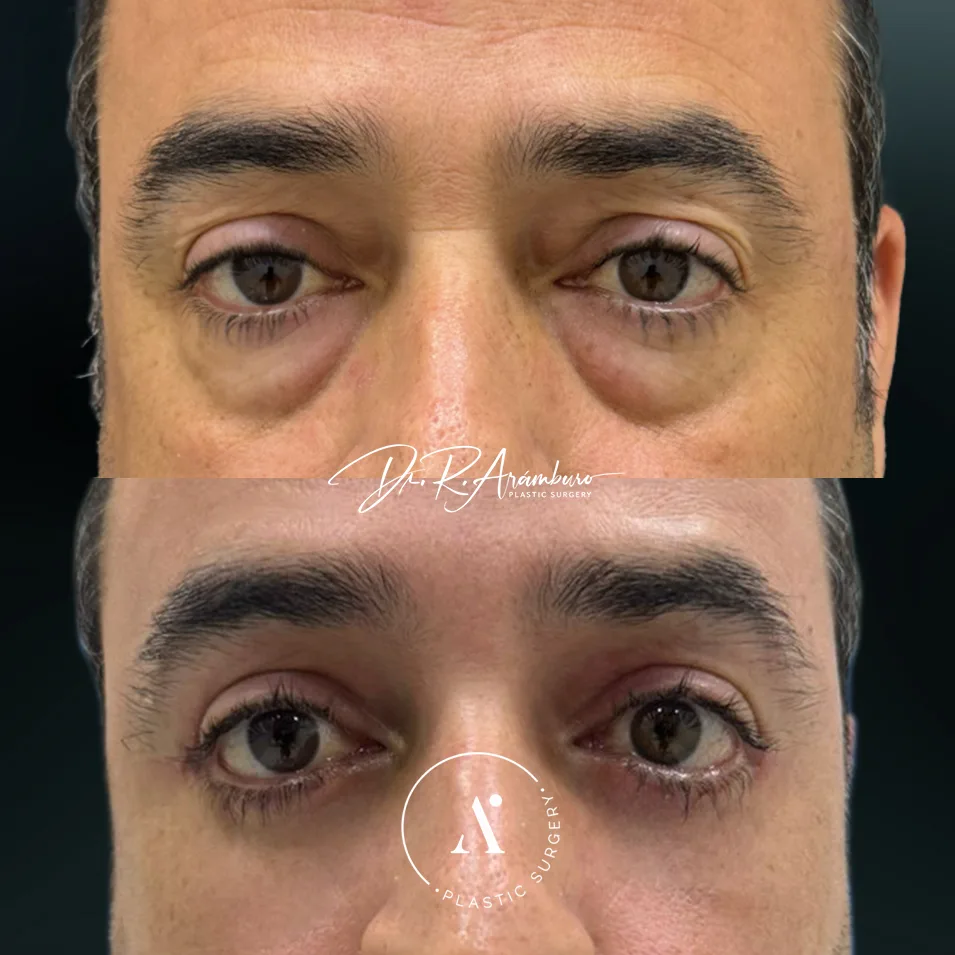 BLEFAROSUPERIOREINFERIOR