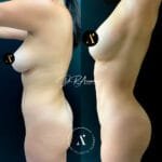 lateral